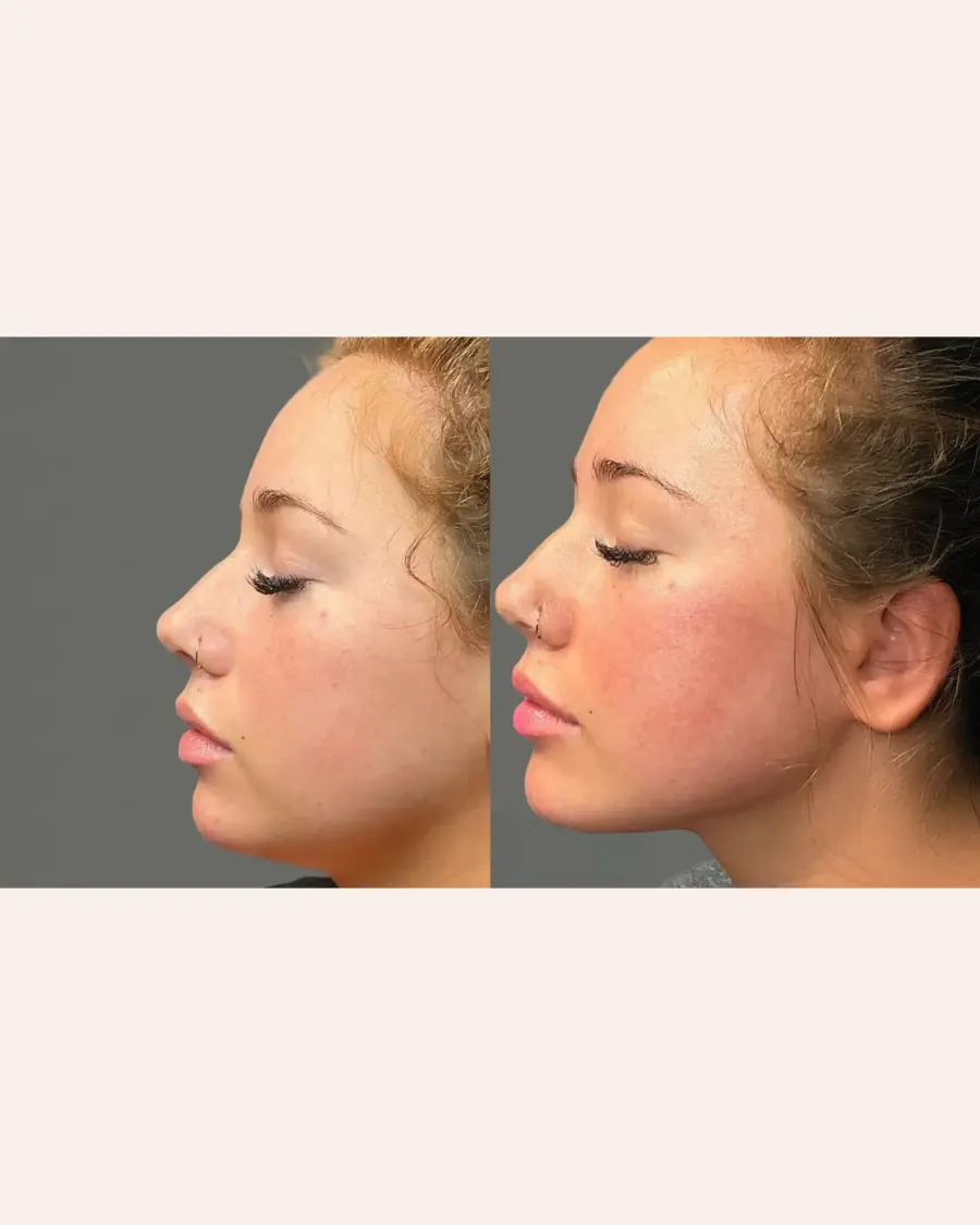 Jawline Contouring at Cinch Clinics